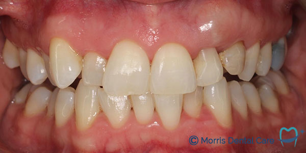 internal bleaching is used by dentists to safely lighten a darkened front tooth